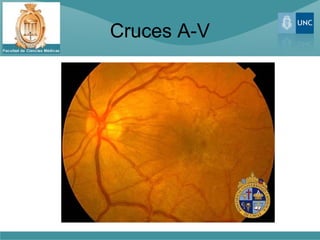 Cruces A-V
 