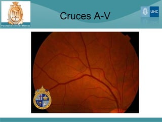 Cruces A-V
 