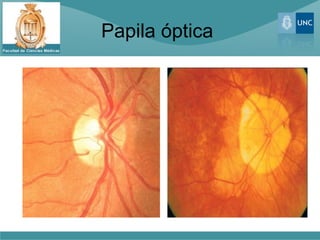 Papila óptica
 