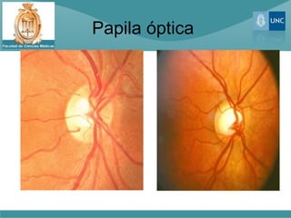 Papila óptica
 