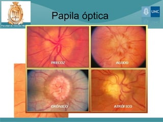Papila óptica
 