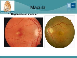 Macula
 Degeneracion macular
 