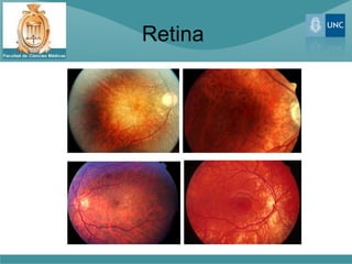 Retina
 