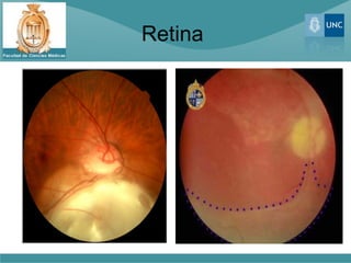 Retina
 