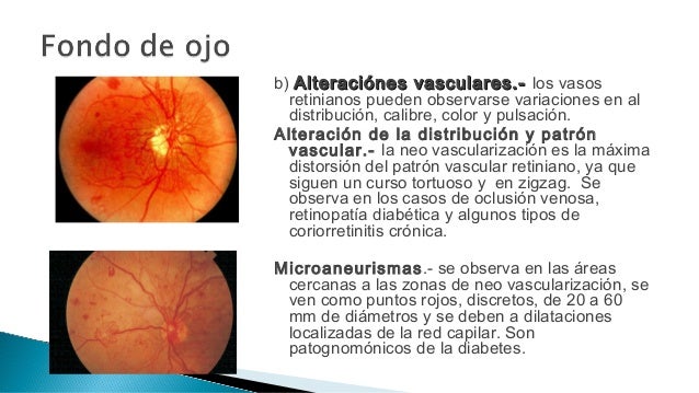 Fondo de ojo