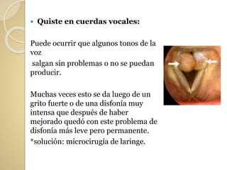  Quiste en cuerdas vocales:
Puede ocurrir que algunos tonos de la
voz
salgan sin problemas o no se puedan
producir.
Muchas veces esto se da luego de un
grito fuerte o de una disfonía muy
intensa que después de haber
mejorado quedó con este problema de
disfonía más leve pero permanente.
*solución: microcirugía de laringe.
 