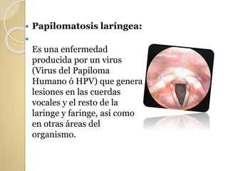  Papilomatosis laríngea:

Es una enfermedad
producida por un virus
(Virus del Papiloma
Humano ó HPV) que genera
lesiones en las cuerdas
vocales y el resto de la
laringe y faringe, así como
en otras áreas del
organismo.
 