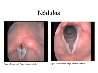 Nódulos
 