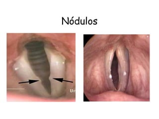 Nódulos
 