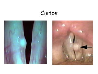 Cistos
 
