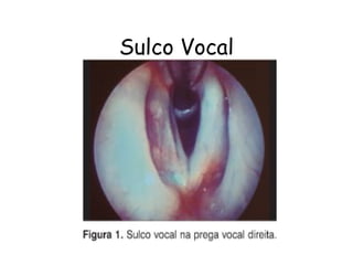 Sulco Vocal
 