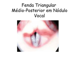 Fenda Triangular
Médio-Posterior em Nódulo
          Vocal
 