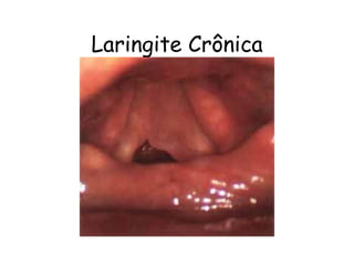 Laringite Crônica
 
