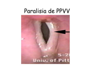 Paralisia de PPVV
 