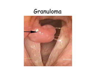Granuloma
 
