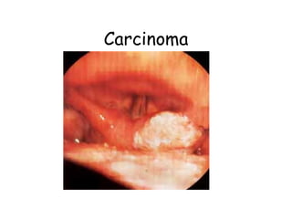 Carcinoma
 