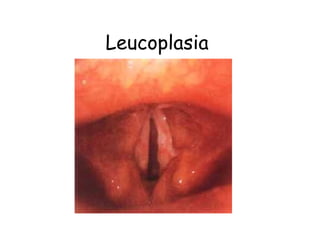 Leucoplasia
 