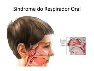 Síndrome do Respirador Oral

 