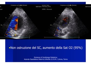 • Non ostruzione del SC, aumento della Sat O2 (95%)

                       Divisione di Cardiologia Pediatrica
          Azienda Ospedaliera Materno-Infantile O.I.R.M.- S.Anna, Torino
 