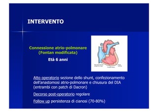 INTERVENTO



Connessione atrio-polmonare
    (Fontan modificata)
         Età 6 anni



 Atto operatorio sezione dello shunt, confezionamento
 dell’anastomosi atrio-polmonare e chiusura del DIA
 (entrambi con patch di Dacron)
 Decorso post-operatorio regolare
 Follow up persistenza di cianosi (70-80%)
 