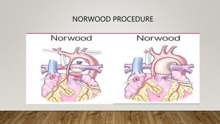 NORWOOD PROCEDURE
 