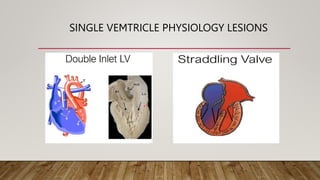 SINGLE VEMTRICLE PHYSIOLOGY LESIONS
 