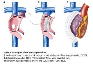 Various techniques of the Fontan procedure.
A, Atriopulmonary connection. B, Lateral tunnel total cavopulmonary connection (TCPC).
C, Extracardiac conduit TCPC. IVC indicates inferior vena cava; RA, right
atrium; RPA, right pulmonary artery; and SVC, superior vena cava.
 