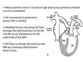• When patients reach 1–5 years of age total cavo pulmonary Fontan
circuit is completed
• IVC connected to pulmonary
artery with a conduit
• Modified Fontan directing IVC flow
through the lateral portion of the RA
into PA via an anastomosis to the
underside of the RPA
• SVC flow is already directed into the
RPA by a previous bidirectional
Glenn shunt
 