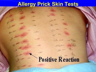 Allergy Prick Skin Tests                                                                                                       