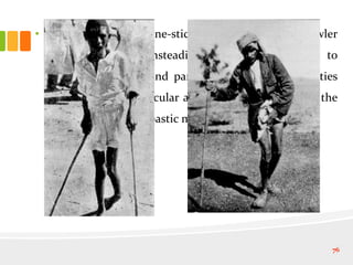 • This is followed by one-stick, two-stick and the crawler
stages when the unsteadiness of gait progresses to
muscular spasticity and paraplegia of lower extremities
accompanied by muscular atrophy, making it one of the
most dreadful toxic spastic myelopathies.
76
 