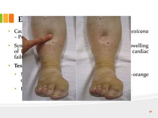 Epidemic dropsy
• Cause: Sanguinarine in Argemone oil (Argemone mexicana
– Prickly poppy).
• Symptoms: sudden, non-inflammatory, bilateral swelling
of legs, often associated with diarrhoea; dyspnea, cardiac
failure and death; mortality = 50%.
• Tests for contamination:
• Nitric Acid Test: development of brown to red-orange
colour (sensitivity 0.25%).
• Paper chromatography test: sensitivity 0.0001%.
91
 