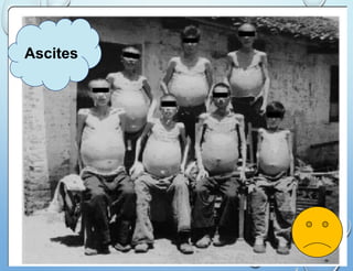 Ascites
 