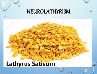 NEUROLATHYRISM
Lathyrus Sativum
 