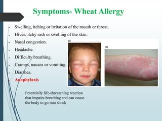 Symptoms- Wheat Allergy
 Swelling, itching or irritation of the mouth or throat.
 Hives, itchy rash or swelling of the skin.
 Nasal congestion.
 Headache.
 Difficulty breathing.
 Cramps, nausea or vomiting.
 Diarrhea.
 Anaphylaxis
Potentially life-threatening reaction
that impairs breathing and can cause
the body to go into shock
 
