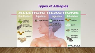 3
Types of Allergies
 