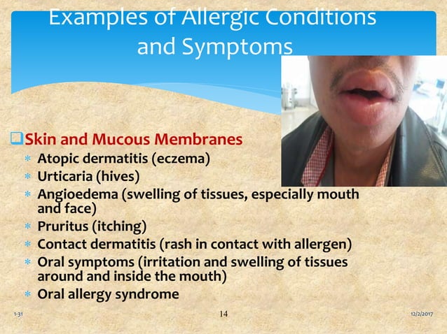 Food allergies and food intolerances ppt | PPTX
