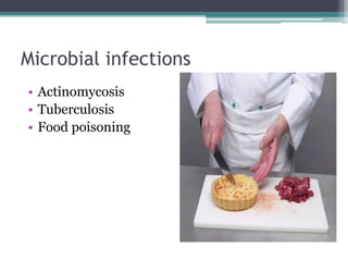 Microbial infections
• Actinomycosis
• Tuberculosis
• Food poisoning
 