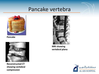 Pancake Sign Radiopedia Food signs in radiology pp ta | PPTX