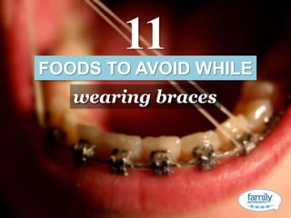 atlanta orthodontics
FOODS TO AVOID WHILE
wearing braces
11
 