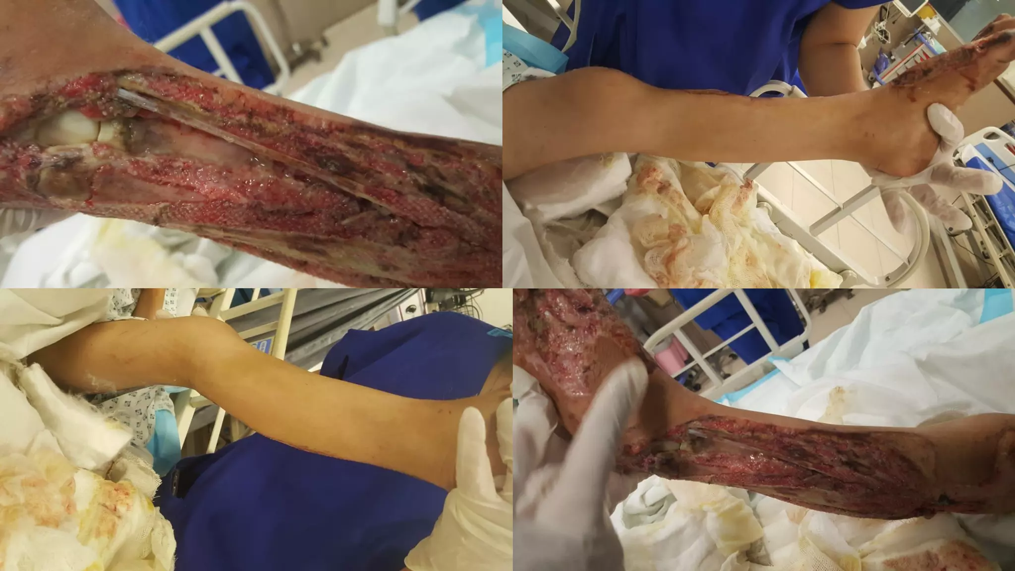 Foot and ankle reconstruction.ppt