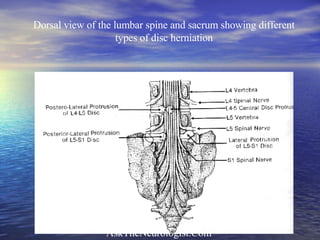 Dorsal view of the lumbar spine and sacrum showing different types of disc herniation 