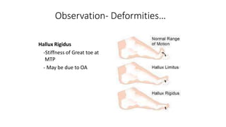 Observation- Deformities…
Hallux Rigidus
-Stiffness of Great toe at
MTP
- May be due to OA
 