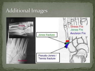 Jones Fracture | PPTX
