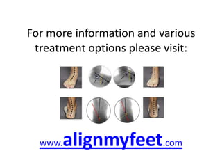 Foot Alignment - | PPTX