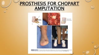 Amputations of foot and it's rehabilitation.pptx | Death, Injury, or ...