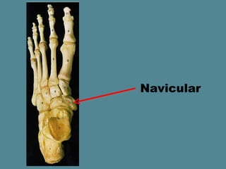 Navicular
 