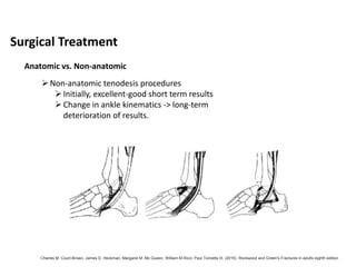 Non-anatomic tenodesis procedures
Initially, excellent-good short term results
Change in ankle kinematics -> long-term
deterioration of results.
Surgical Treatment
Anatomic vs. Non-anatomic
Charles M. Court-Brown, James D. Heckman, Margaret M. Mc Queen, William M Ricci, Paul Tornetta III. (2015). Rockwood and Green's Fractures in adults eighth edition
 