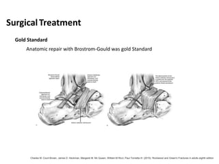 SurgicalTreatment
Gold Standard
Anatomic repair with Brostrom-Gould was gold Standard
Charles M. Court-Brown, James D. Heckman, Margaret M. Mc Queen, William M Ricci, Paul Tornetta III. (2015). Rockwood and Green's Fractures in adults eighth edition
 