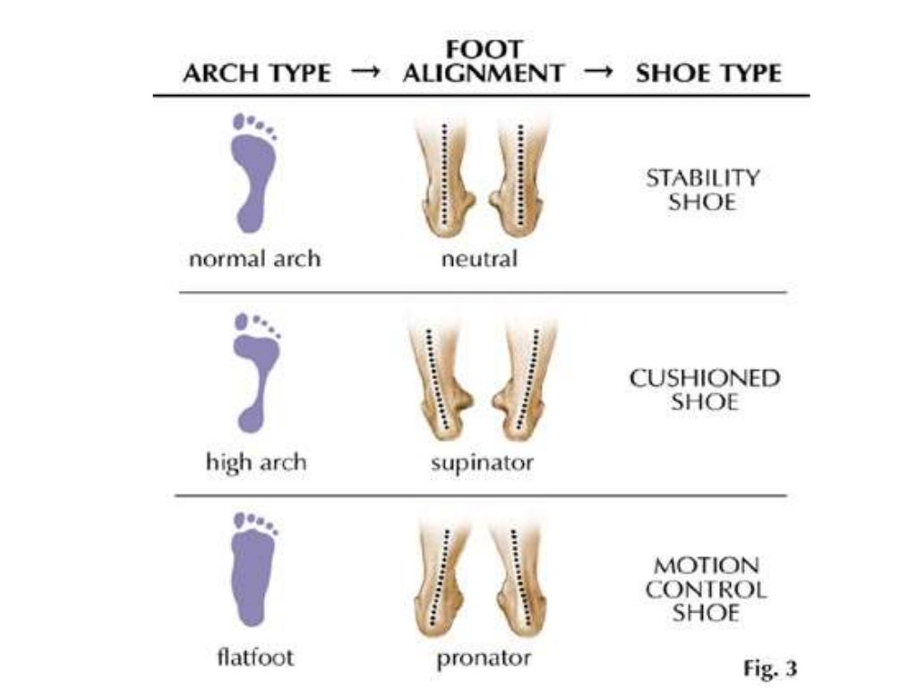 Foot arch deformities 2