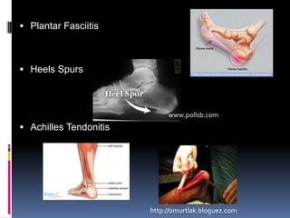 ArthritisOsteoarthritisRheumatoid arthritisFoot carehttp://www.joint-pain-solutions.com/images/arthritis_osteoarthritis.jpgwww.stevenage-podiatry.co.uk